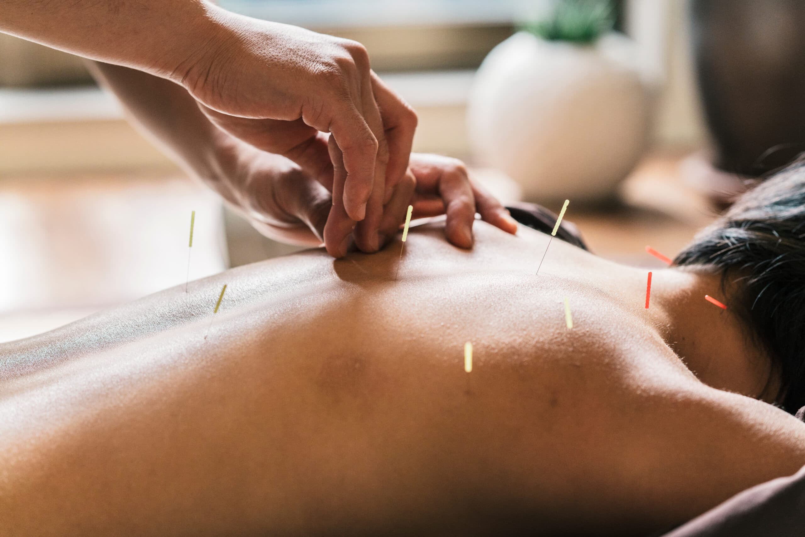 Acupuncture Therapy